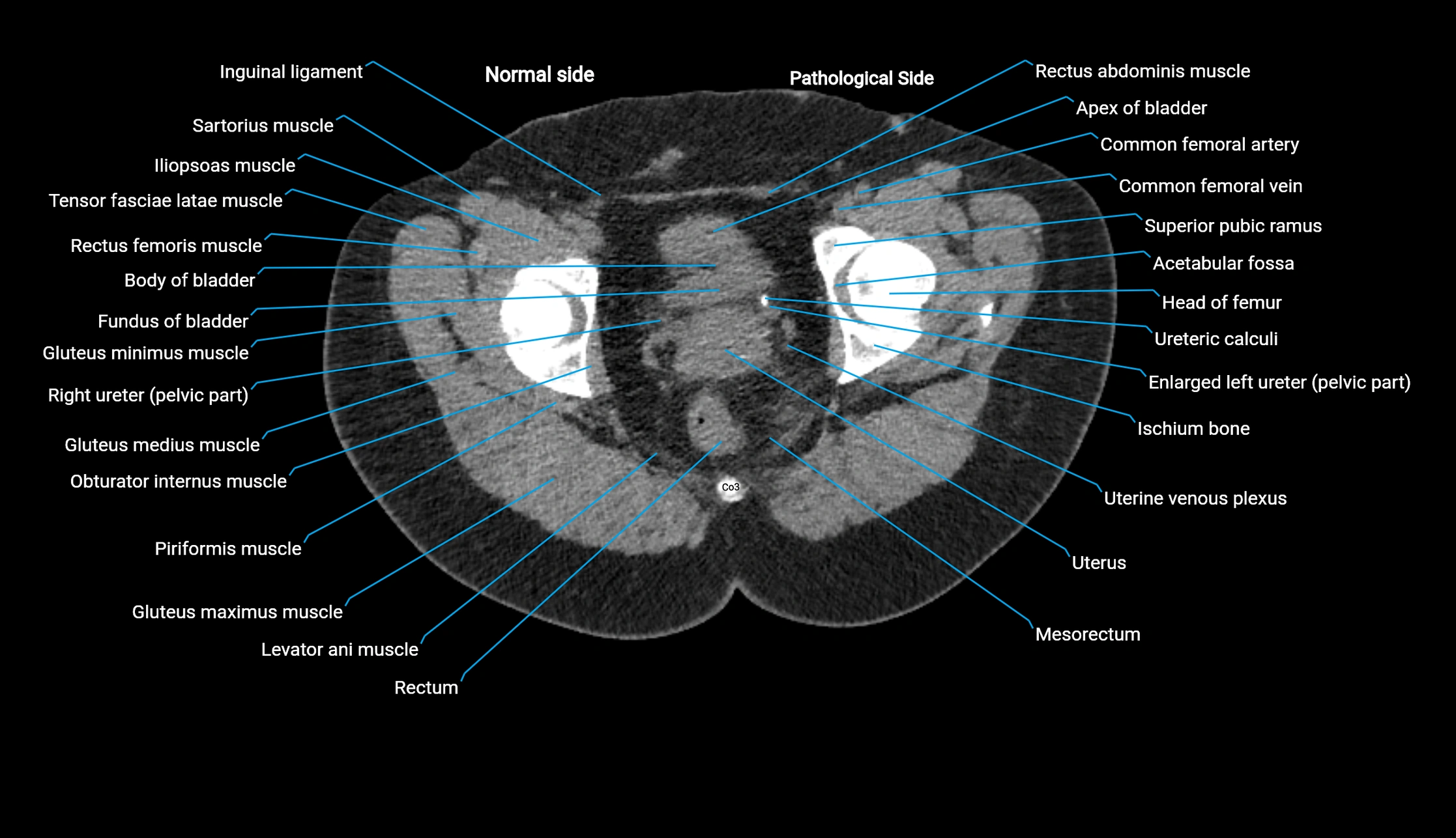 CT KUB axial cross sectional anatomy  radiology image -img-00201-00157.webp